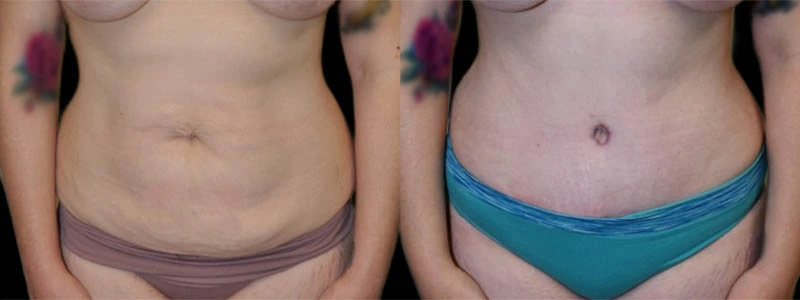 Anterior view of torso before and after body contouring treatment