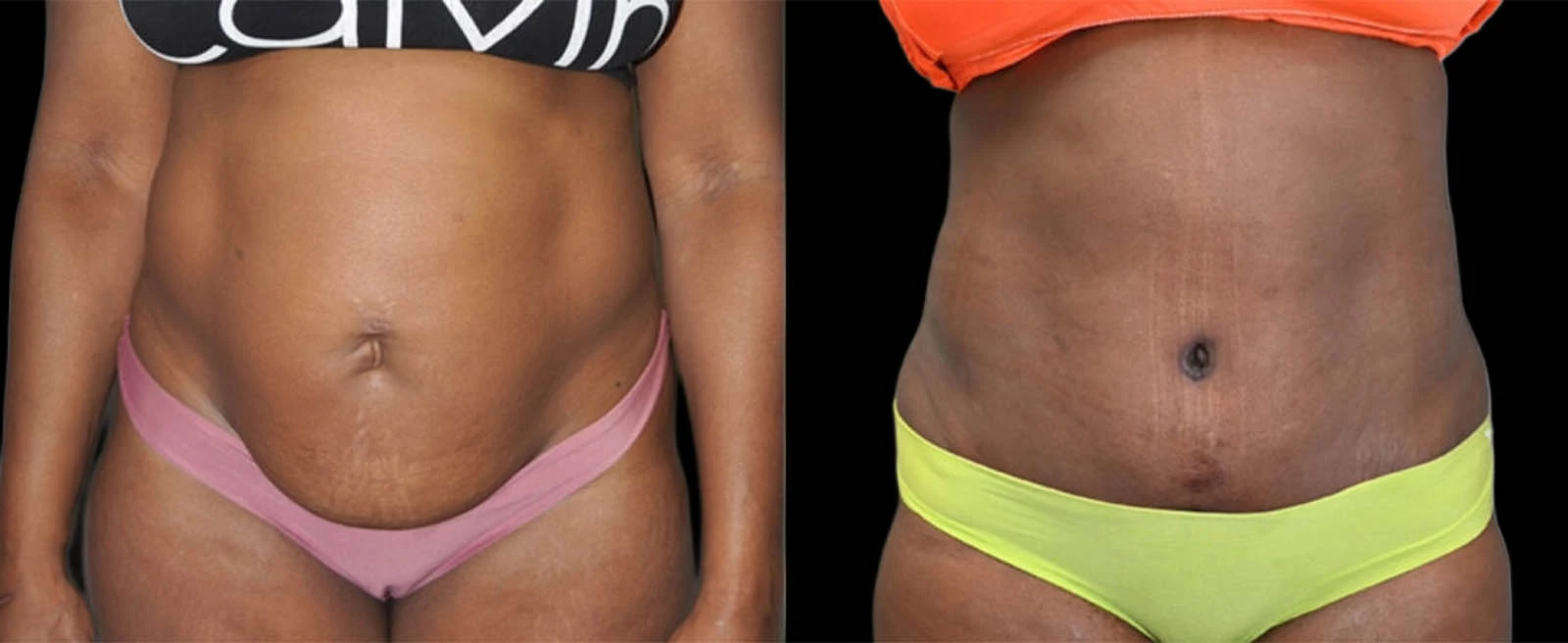 Front view before and after torso showing more sculpted abdominal contour
