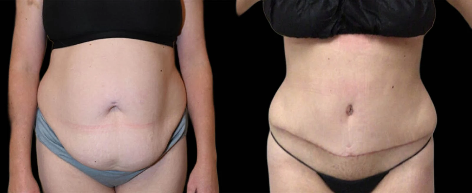 Before and after abdominal contouring, frontal view showing reduced abdominal fullness