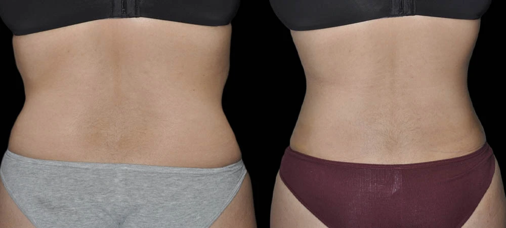 Before and after back view showing smoother waist contour and improved body shape