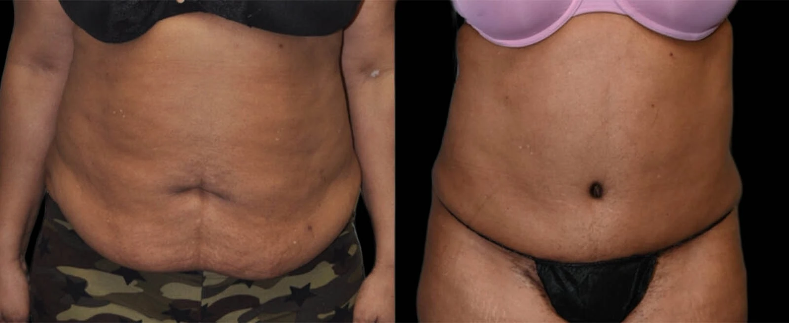 Before and after abdominal contouring showing reduced loose skin and improved waistline definition