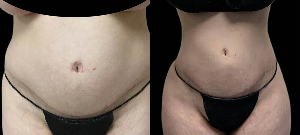 Before and after front view showing reduced abdominal fullness and defined waistline