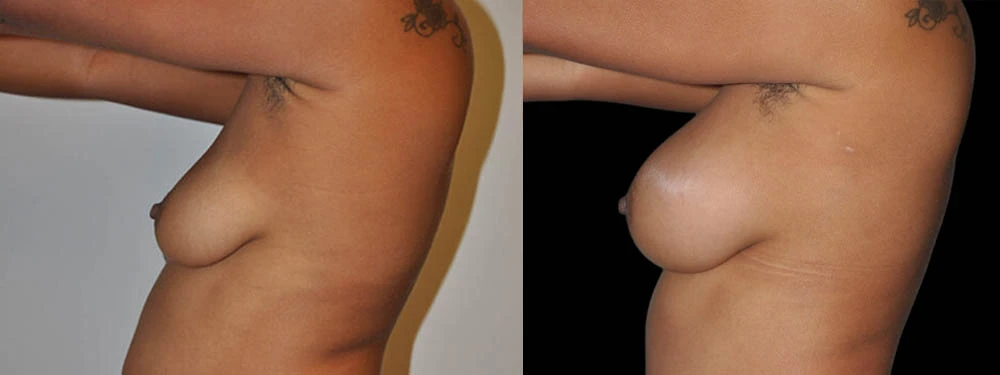 0001_BREASTS-LEFT-LATERAL-VIEW-AFTER.JPG