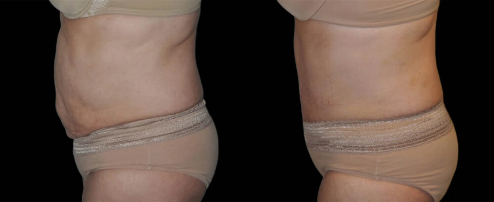 Left lateral view before and after body contouring showing reduced abdominal skin laxity