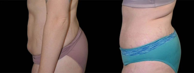 Left lateral view of torso before and after body contouring treatment