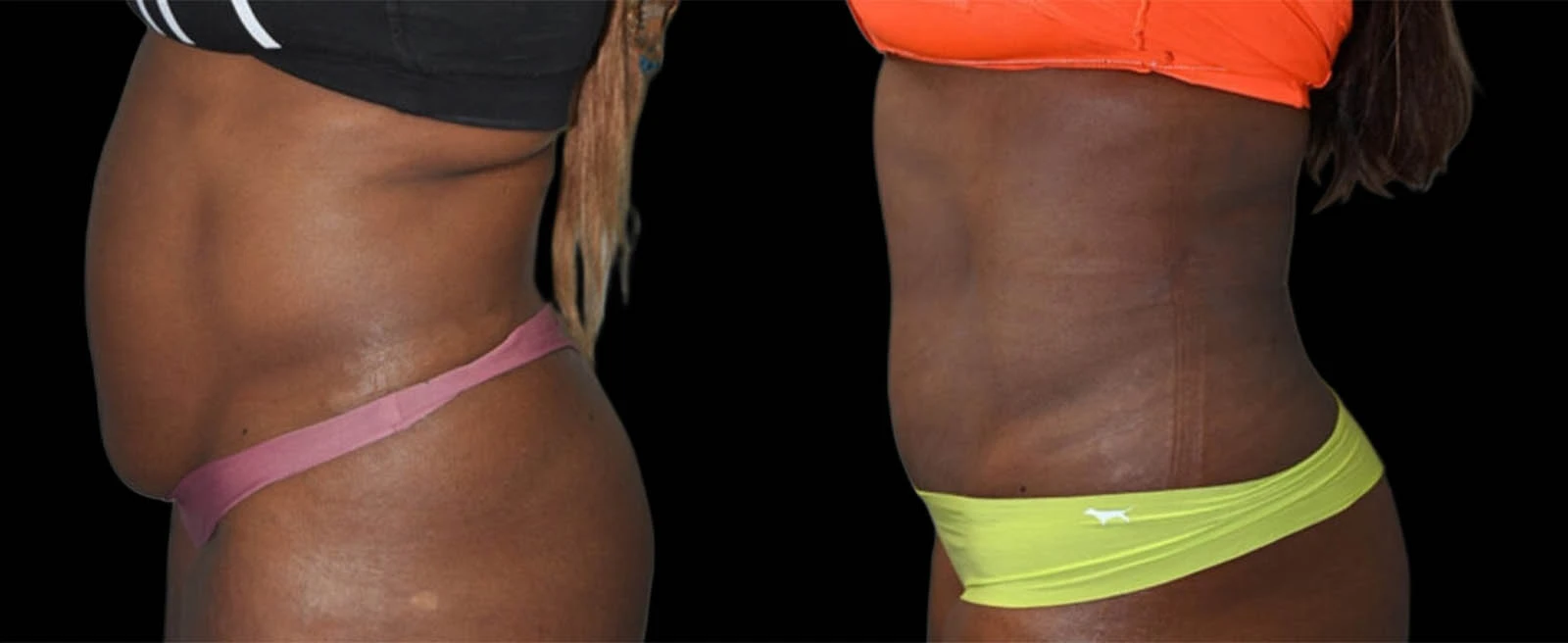 Left lateral before and after torso showing enhanced body definition