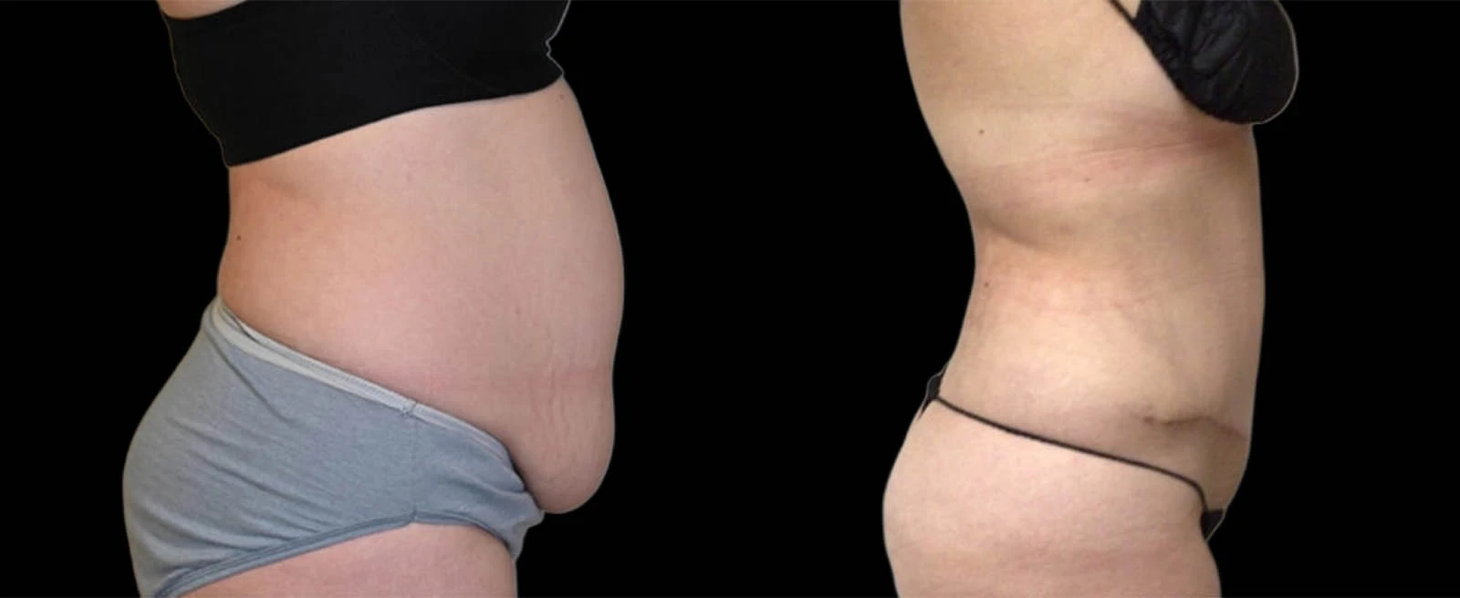 Right lateral view of torso before and after body contouring treatment