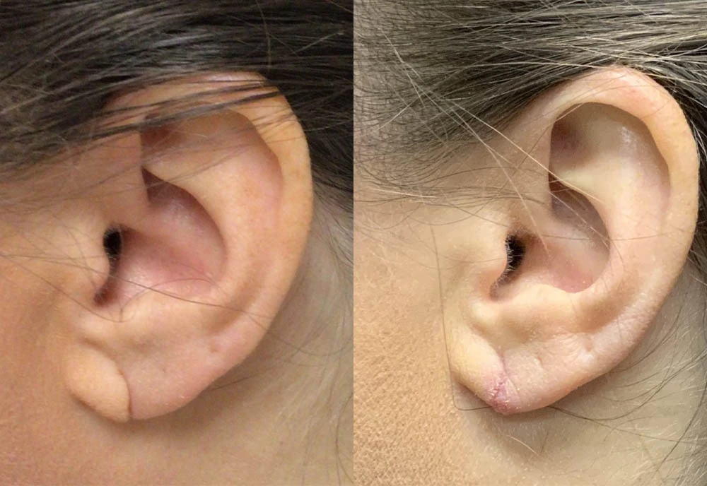0001_left-ear-after.JPEG