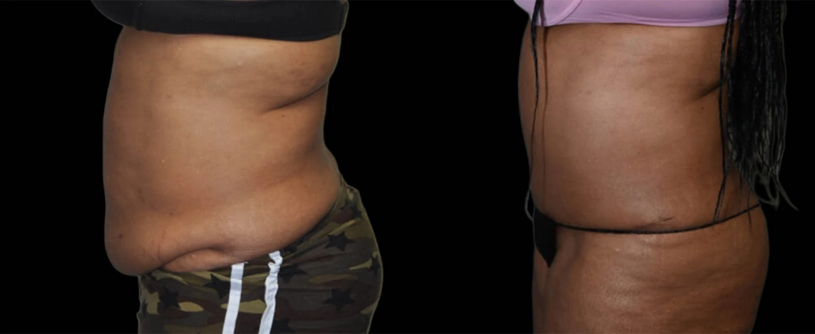 Left lateral before and after views showing flattened midsection and enhanced abdominal definition