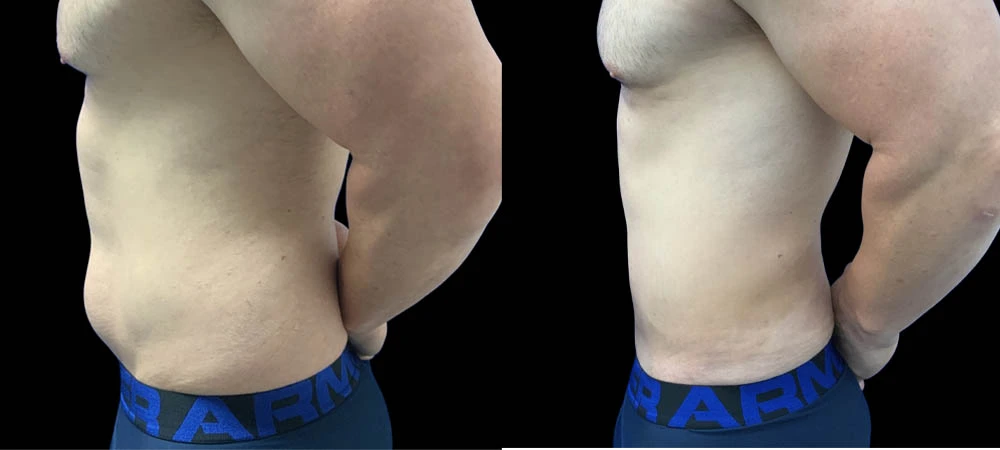 0001_lipo1of03.JPEG