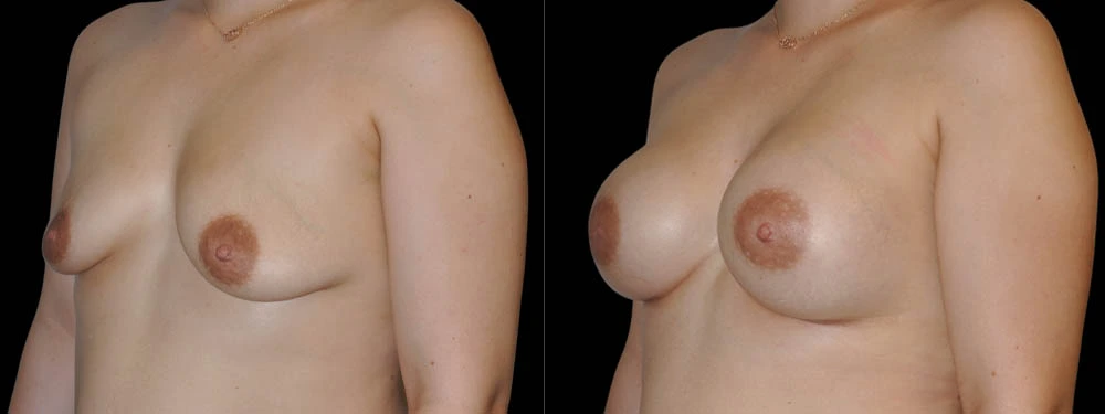 0002_2BREASTS-LEFT-OBLIQUE-VIEW-AFTER.JPG