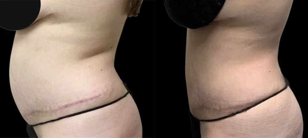 Before and after left lateral view showing decreased abdominal projection and improved silhouette