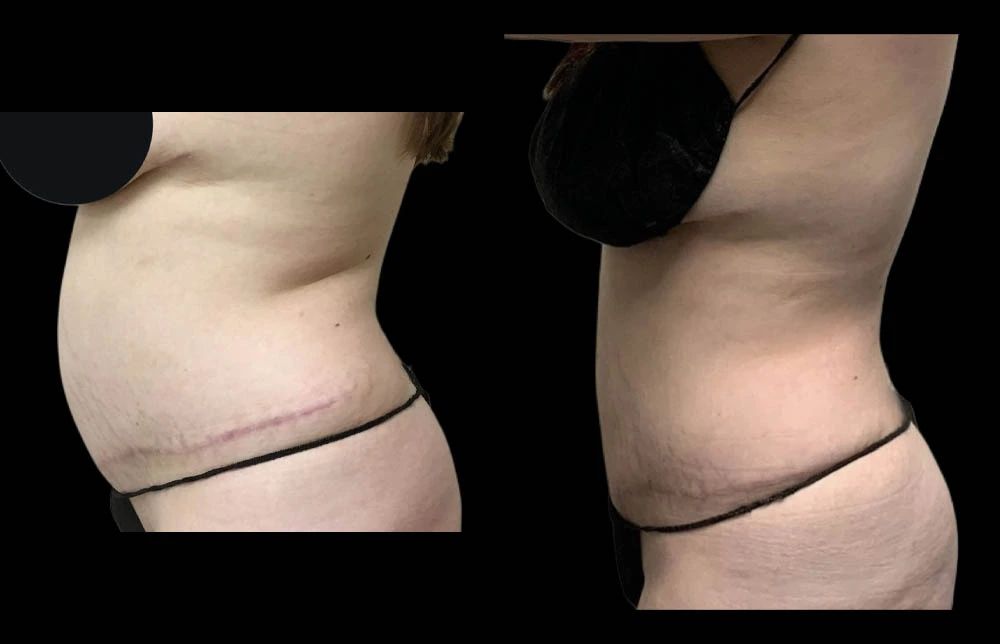 0002_ABDOMEN-BACK-LEFT-LATERAL-VIEW-BEFORE.jpg