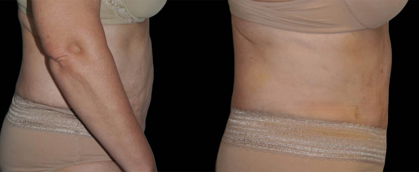Before and after abdominal contouring, side view showing improved definition and contour