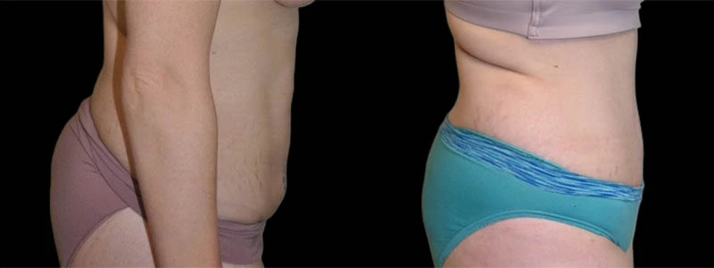 Right lateral before and after lower torso and leg showing improved body shape