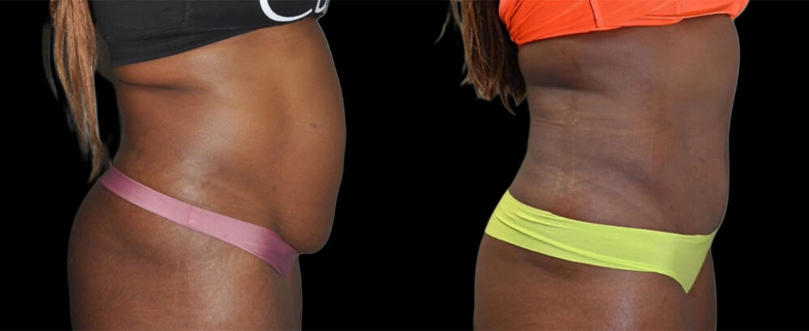 Right lateral before and after torso showing improved waist contour