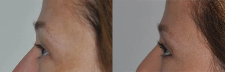 0002_eyes-left-lateral-lateral-view-before.JPG