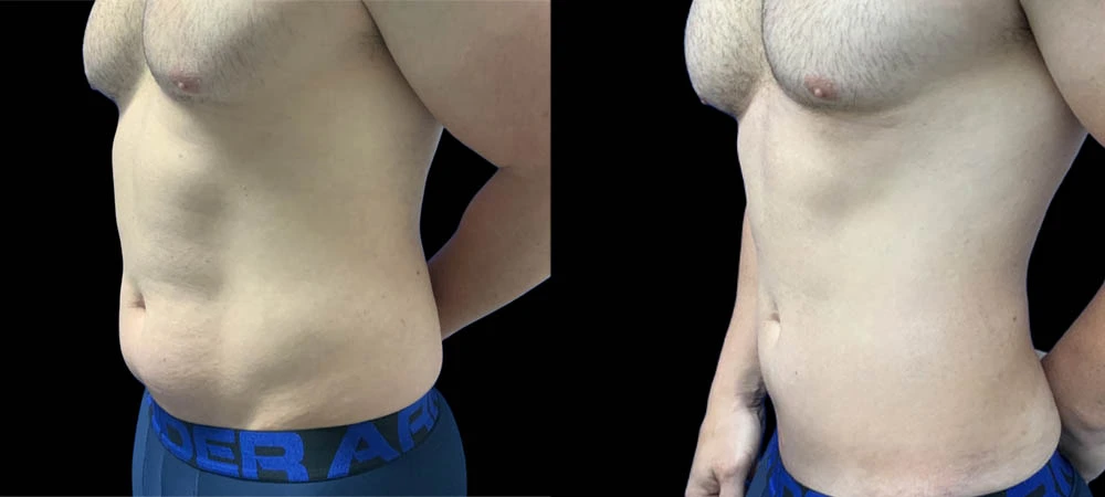 0002_lipo1of06.JPEG