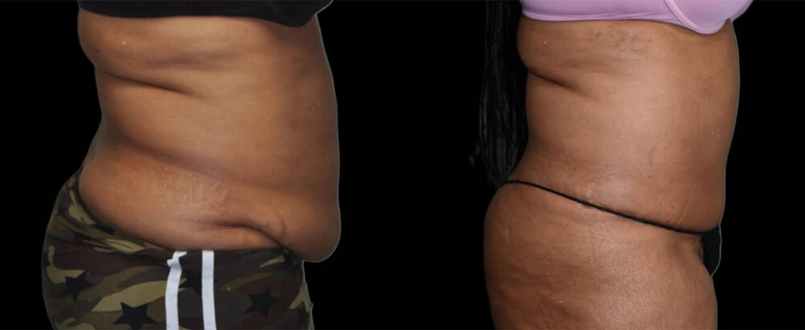 Right lateral before and after views of torso showing reduced fat deposits and improved body contour
