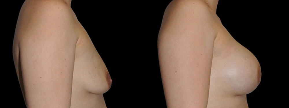 0003_2BREASTS-RIGHT-LATERAL-VIEW-AFTER.JPG