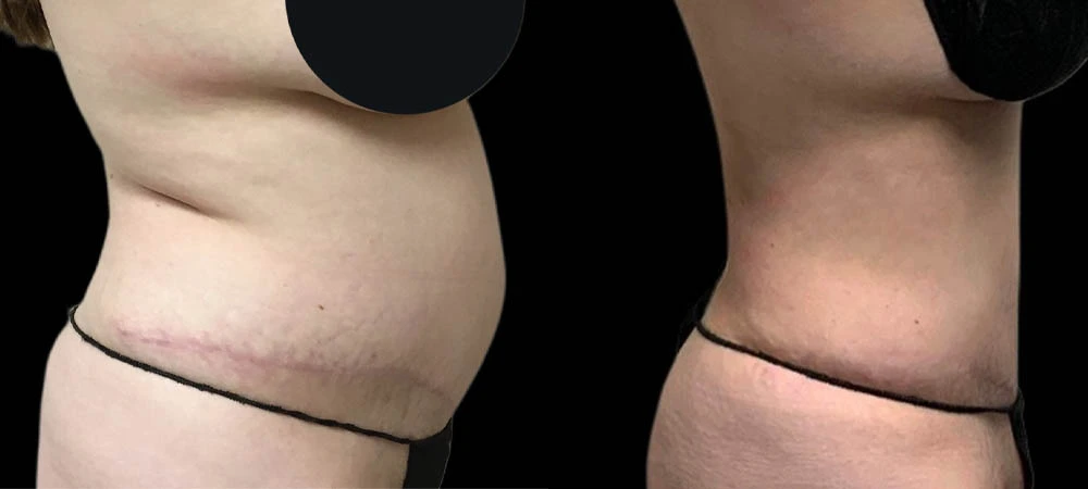 Before and after right lateral view showing flatter abdomen and refined waistline