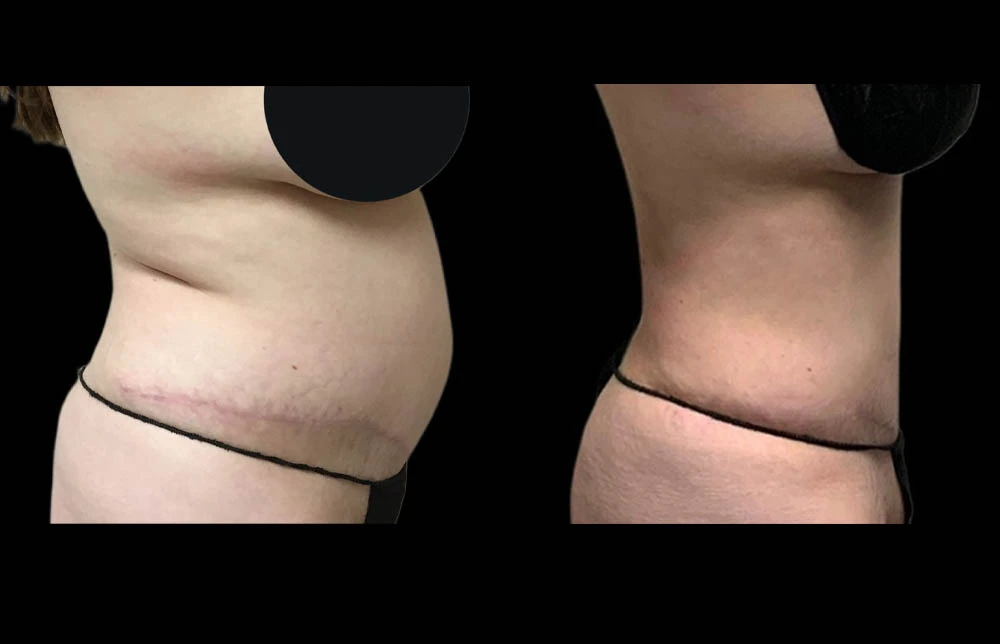 0003_ABDOMEN-BACK-RIGHT-LATERAL-VIEW-BEFORE.jpg