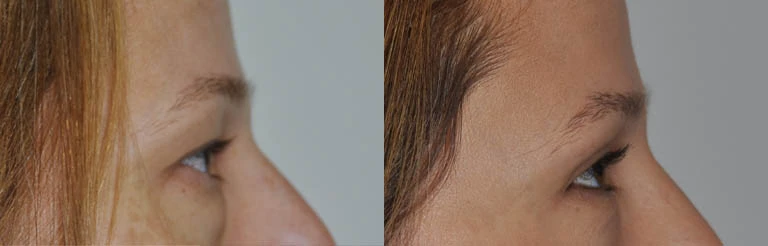 0003_eyes-right-lateral-view-before.JPG