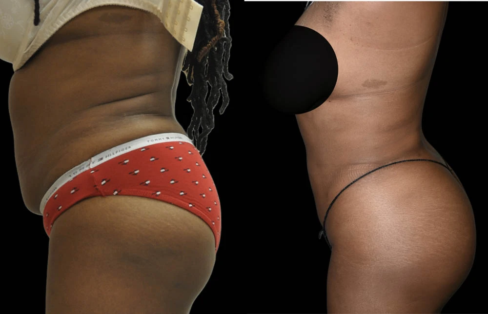 0004_ABDOMEN-BUTTOCK-LEFT-LATERAL-VIEW-BEFORE.jpg (1)