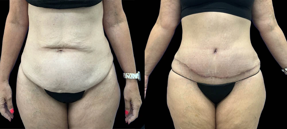 Anterior abdomen view before and after, showing reduced abdominal fullness and improved contour definition