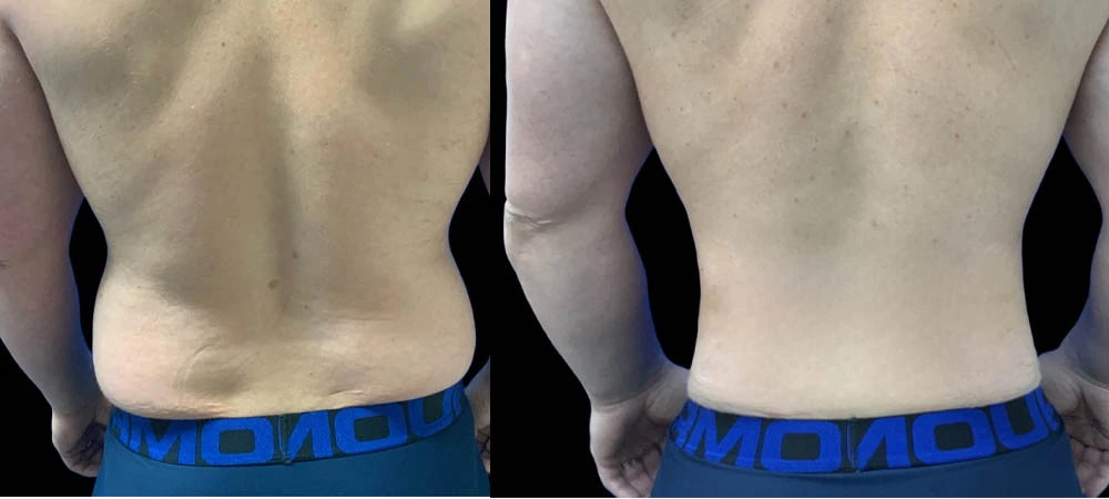 0005_lipo1of12.JPEG