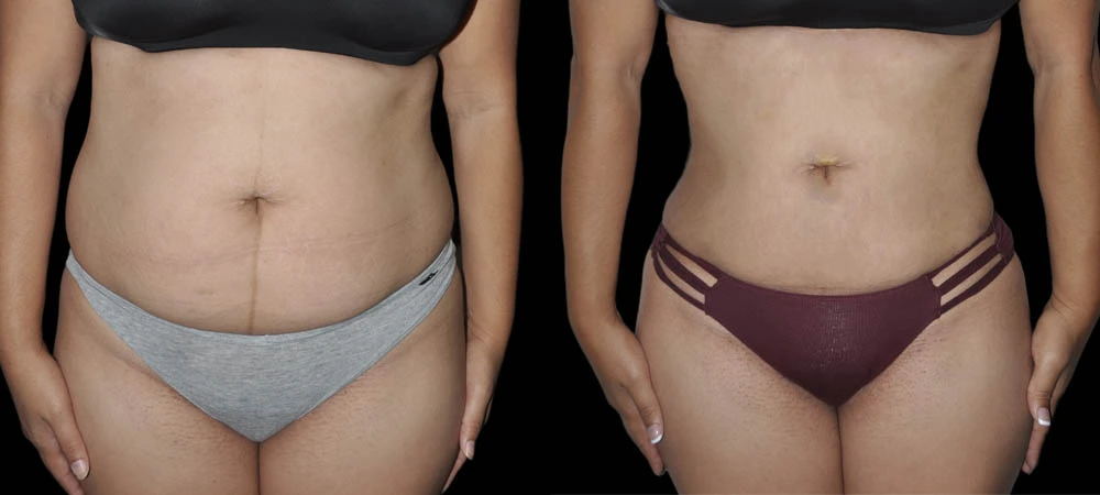 Before and after front abdominal view showing improved core definition and skin tightness