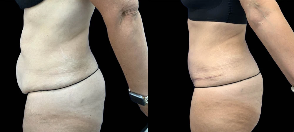 Left lateral abdomen view before and after, showing decreased projection and improved silhouette