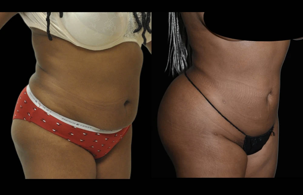0006_ABDOMEN-RIGHT-OBLIQUE-VIEW-BEFORE.jpg (1)
