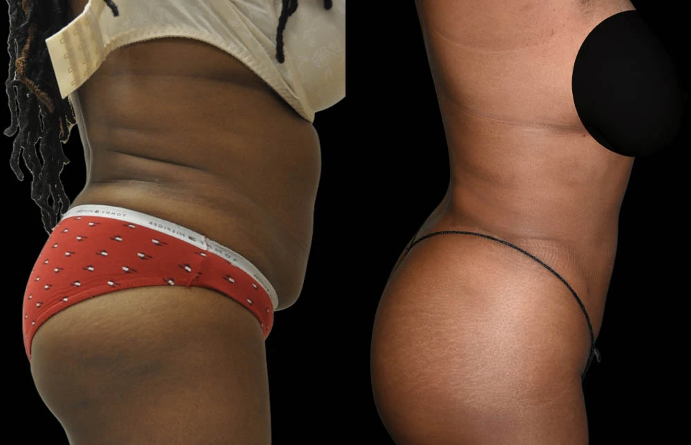 0007_ABDOMEN-BUTTOCK-RIGHT-LATERAL-VIEW-BEFORE.jpg (1)
