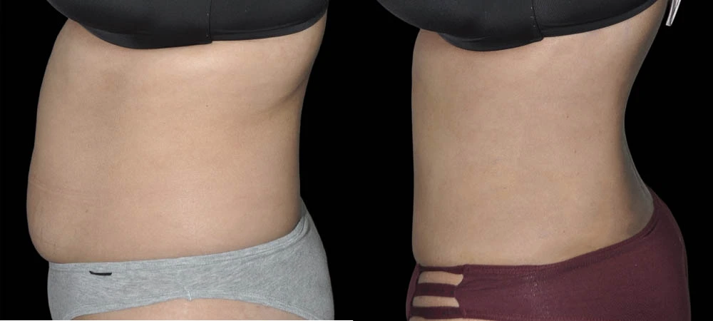 Before and after abdominal left lateral view showing reduced midsection fullness