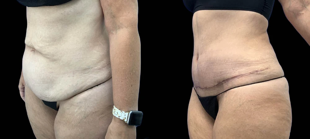 Left oblique abdomen view before and after, showing reduced fullness and improved body shape