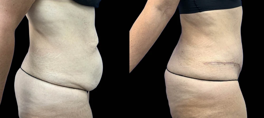 Right lateral abdomen view after body contouring, showing flattened profile and defined waistline