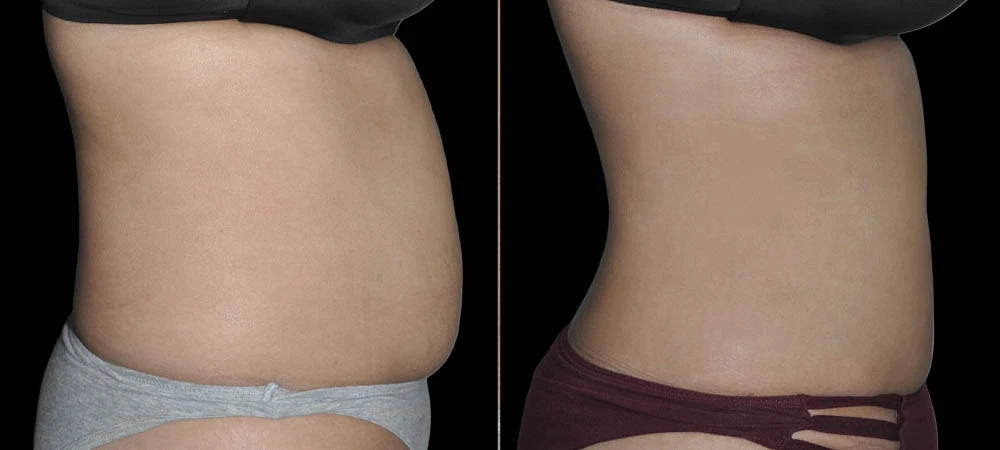 Before and after right side view showing flatter abdominal profile and enhanced waist definition