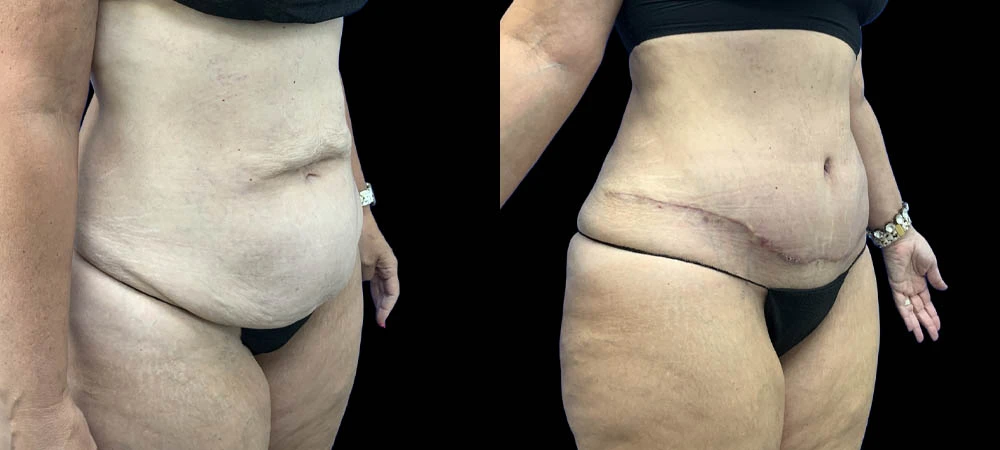 Right oblique abdomen view before and after, showing decreased abdominal protrusion and improved contour