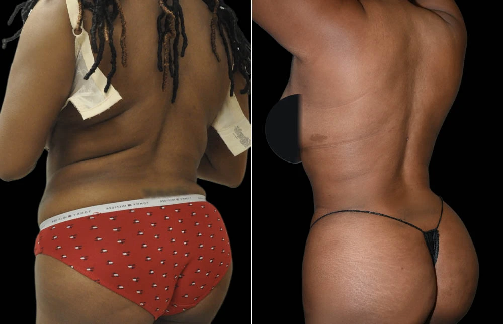 0009_BACK-BUTTOCK-LEFT-OBLIQUE-VIEW-BEFORE.jpg
