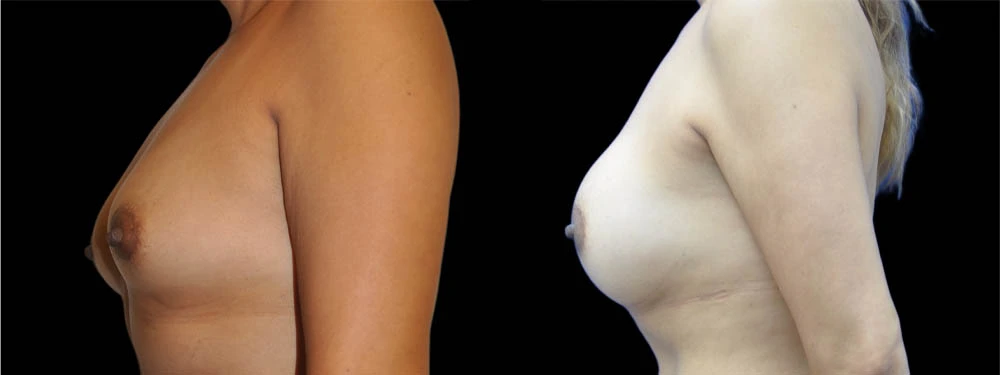 0009_BREASTS-LEFT-LATERAL-VIEW-AFTER.jpeg