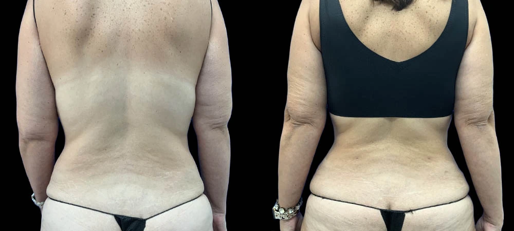 Back view before and after body contouring, showing reduced fullness and improved definition