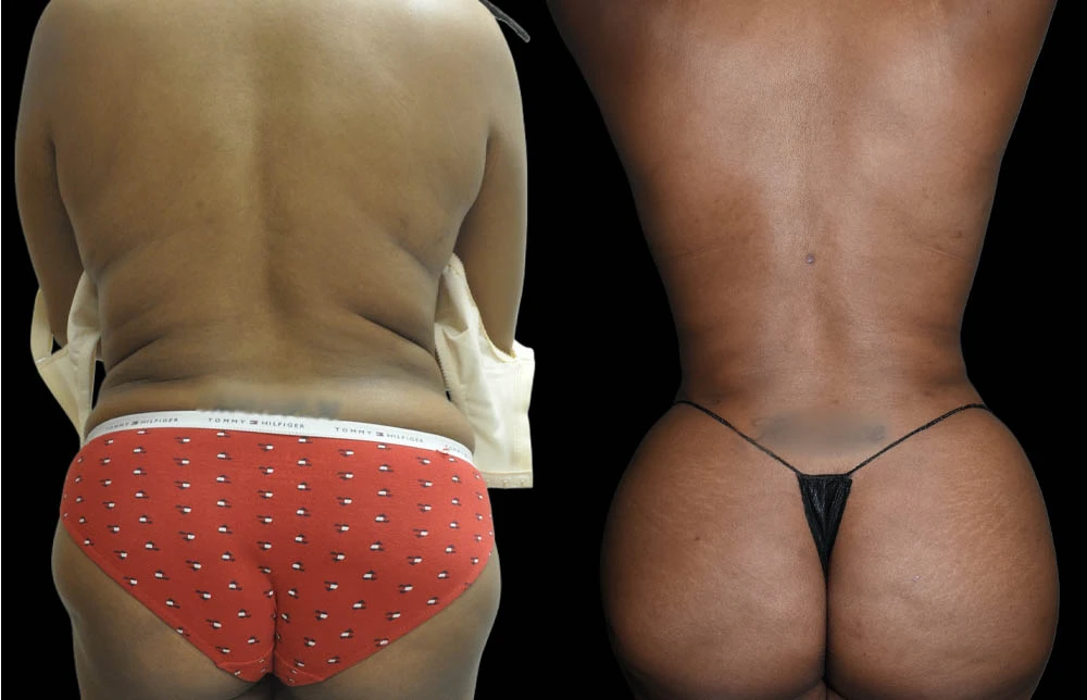 0010_BACK-BUTTOCK-POSTERIOR-VIEW-BEFORE.jpg (1)