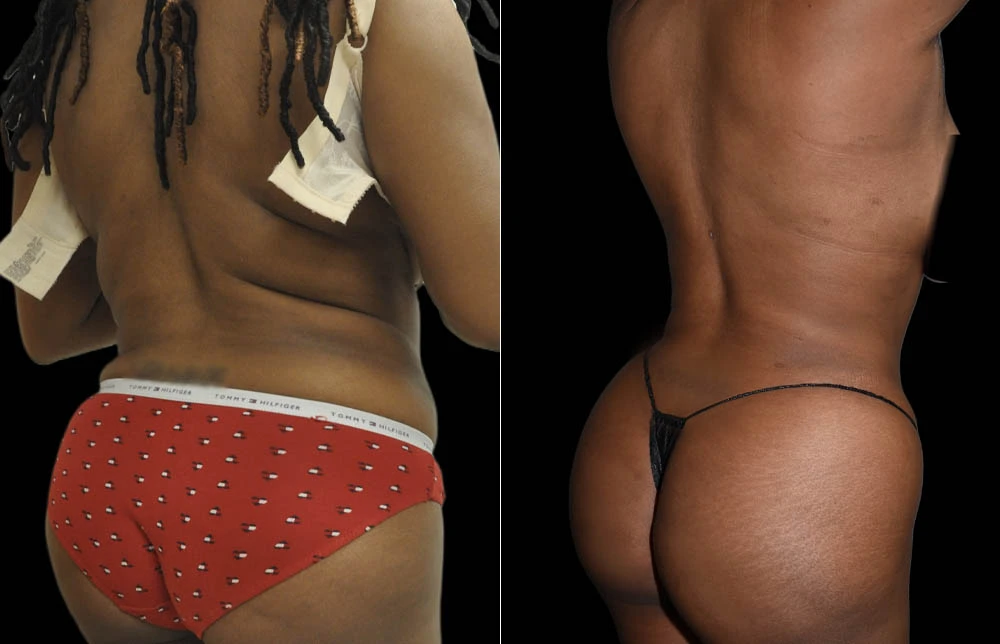 0011_BACK-BUTTOCK-RIGHT-OBLIQUE-VIEW-BEFORE.jpg (1)