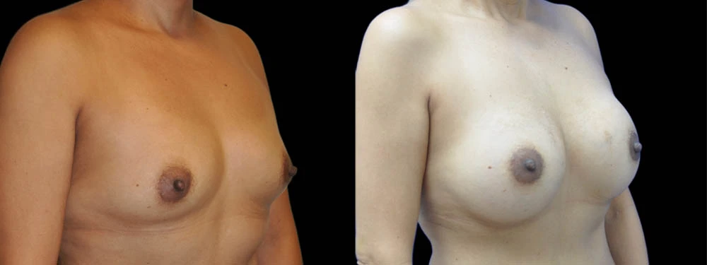 0012_BREASTS-RIGHT-OBLIQUE-VIEW-AFTER.jpeg