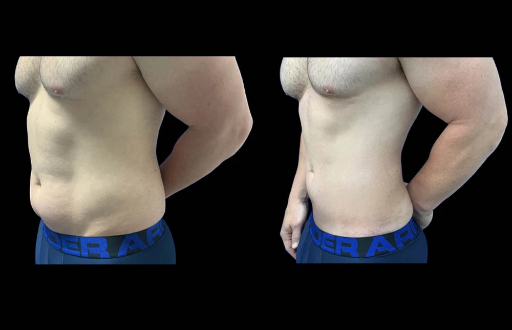 0018_cABDOMEN-LEFT-OBLIQUE-VIEW-BEFORE.JPEG