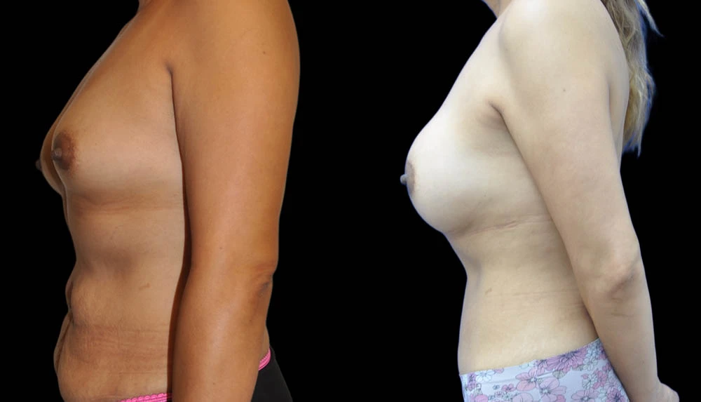 a_0001_BREASTS-ABDOMEN-LEFT-LATERAL-VIEW-AFTER.jpeg