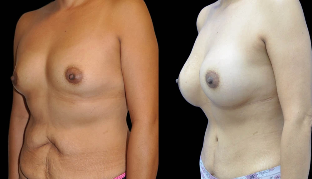 a_0002_BREASTS-ABDOMEN-LEFT-OBLIQUE-VIEW-AFTER.jpeg