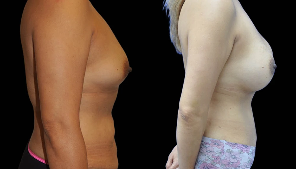 a_0003_BREASTS-ABDOMEN-RIGHT-LATERAL-VIEW-AFTER.jpg