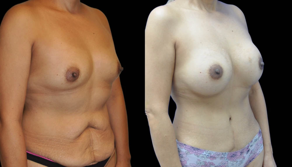 a_0004_BREASTS-ABDOMEN-RIGHT-OBLIQUE-VIEW-AFTER.jpeg